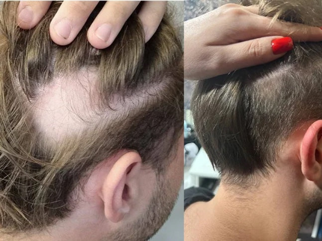 Customer-submitted Fabao before-and-after hair progress photographs, example 1