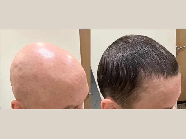 Customer-submitted Fabao before-and-after hair progress photographs, example 4