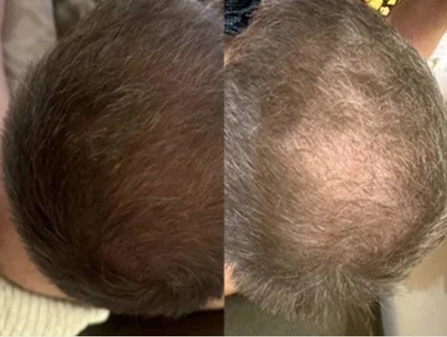 Customer-submitted Fabao before-and-after hair progress photographs, example 6